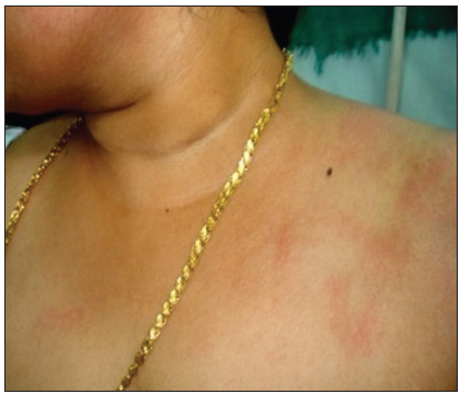 Diffuse ill-defined erythematous rash involving the left side of the upper chest and lower half of face with few spillover lesions on the right side of the chest.