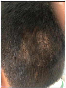 Alopecia or Patchy Baldness  The Homeopathic Approach To Treat It  By  Dr Lalit Kasana  Lybrate