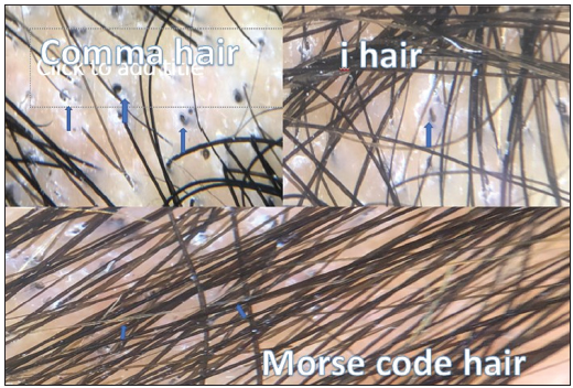 Trichoscopy showing scaling, black dots, comma hair, I hair, and Morse code hair.