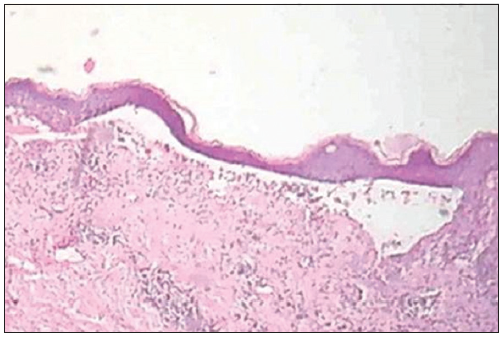Skin biopsy showing subepidermal blister (H and E, ×100).