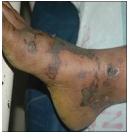 Retiform purpura on foot.