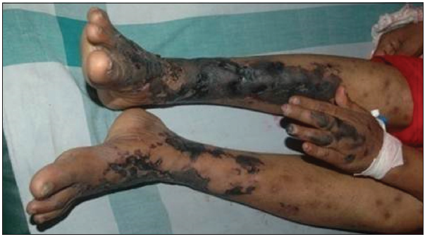 Retiform purpura on legs and gangrene of index finger.