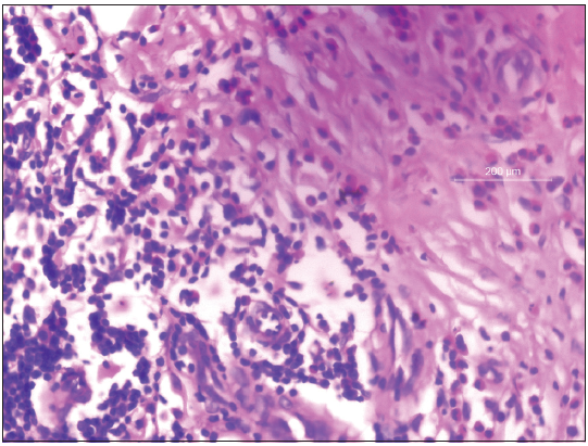 Skin biopsy from retiform purpura showing eosinophilic vasculitis (H and E, ×400).