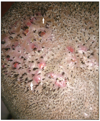“Doll’s hair” sign – multiple hairs arising from a single follicular orifice (white arrows), characteristic of tufted folliculitis.