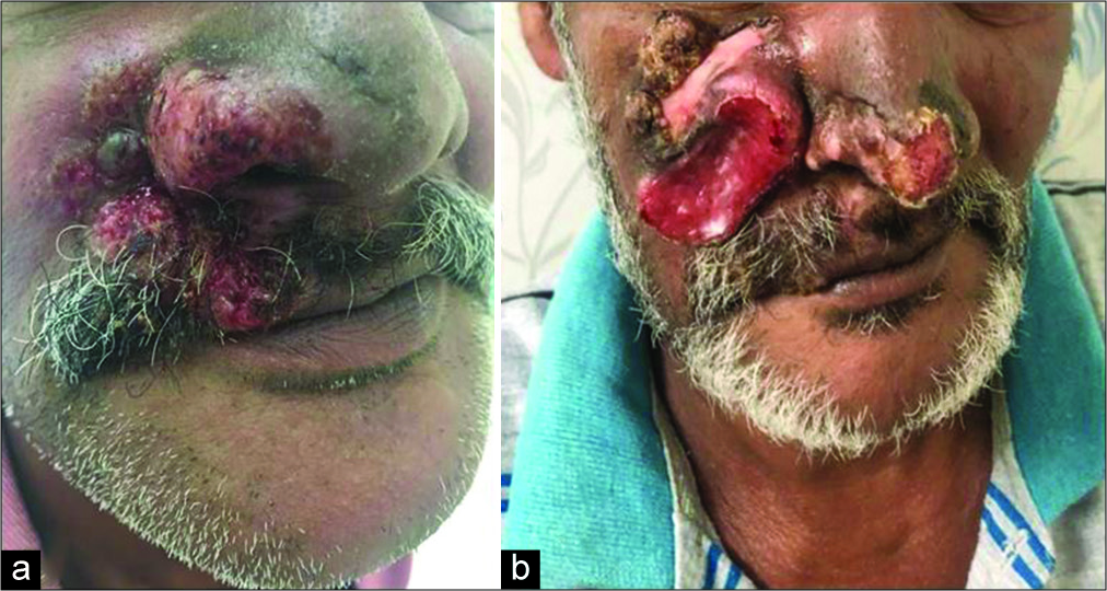 (a) Initial presentation with ulcer over the right side of the face. (b) Presentation after 6 months as ulceroproliferative growth involving the tip of the nose right side of the face.