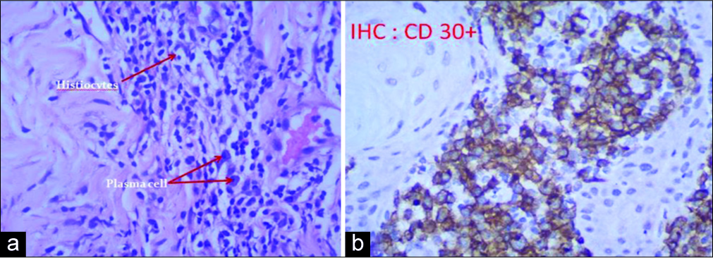 (a) Histopathology showing ill-formed collections of histiocytes and plasma cells in the background of inflammatory infiltrate (H and E, ×200). (b) Immunohistochemistry showing CD30+ cells (DAB chromagen, ×200).