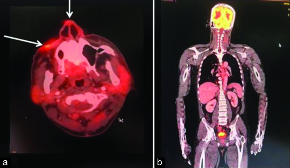 (a) PET scan showing activity confined to the right side of the face. (b) PET scan showing no other areas of activity/involvement.
