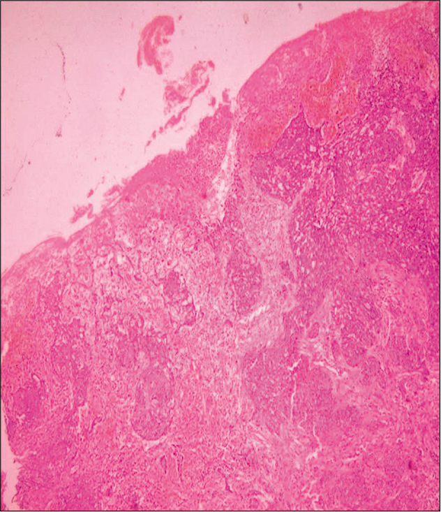 Clinicopathological analysis of basal cell carcinoma – A retrospective ...