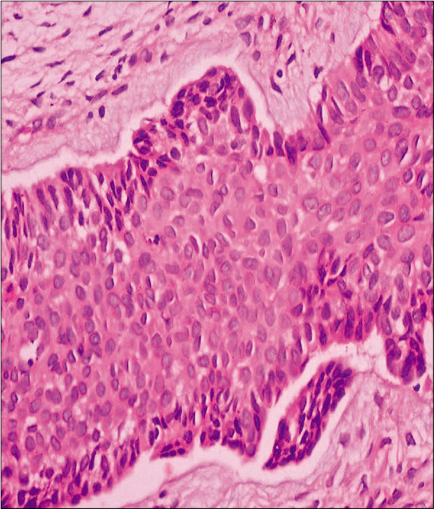 Clinicopathological analysis of basal cell carcinoma – A retrospective ...