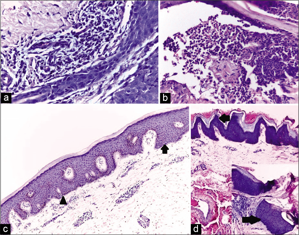 (a) Biopsy from a patient with dermatitis curuis pustolsa et atrophicans showing inflammatory infiltrate around sweat duct, blood vessels, and hair follicle. Infiltrate extending into the epidermis with intercellular edema (H and E, ×100); (b) biopsy from a pustule of dermatitis curuis pustolsa et atrophicans showing neutrophilic abscess in stratum corneum (H and E, ×200); (c) biopsy from dermatitis curuis pustolsa et atrophicans showing broad-based acanthosis in some areas (arrow) and rete pegs beginning to fuse (arrow head) with each other in other areas (H and E, ×100); (d) biopsy from a papule of dermatitis curuis pustolsa et atrophicans showing hyperkeratosis and churchspire papillomatosis (left arrow) (H and E, ×100); inset: Another focus from the same section showing irregular and broad-based acanthosis (right arrow, H and E, ×100).