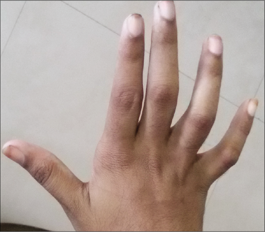 Dorsal view of claw hand.
