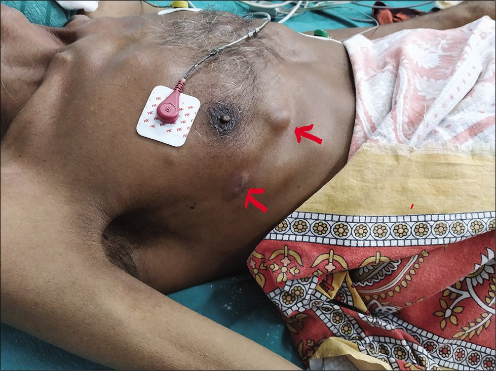 Cutaneous abscess (red arrow).