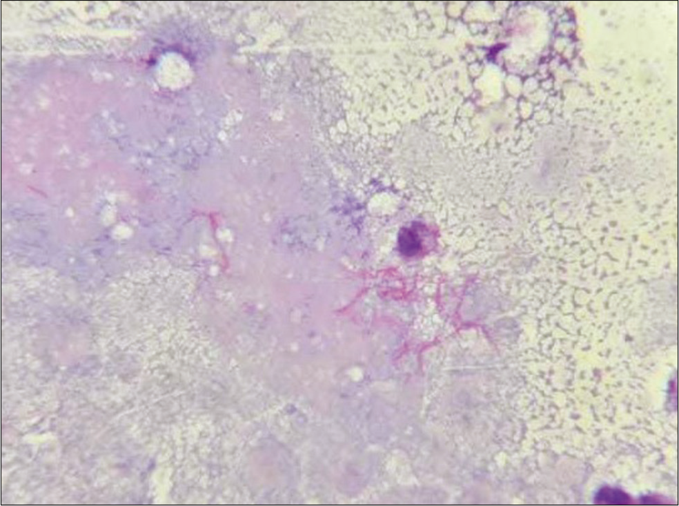 Pus aspirated from cutaneous swellings showing thin filamentous beaded Gram-positive bacilli (Gram stain, ×1000).