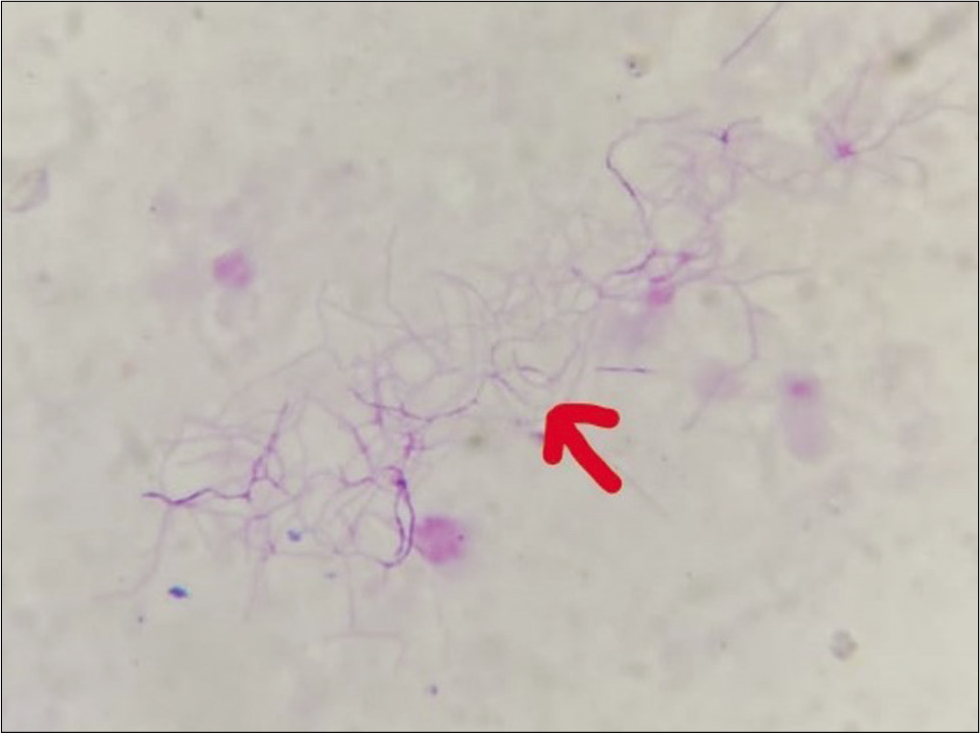 Pus aspirated from cutaneous swellings showing (red arrow) acid-fast bacilli (modified Ziehl-Neelsen stain, ×1000).