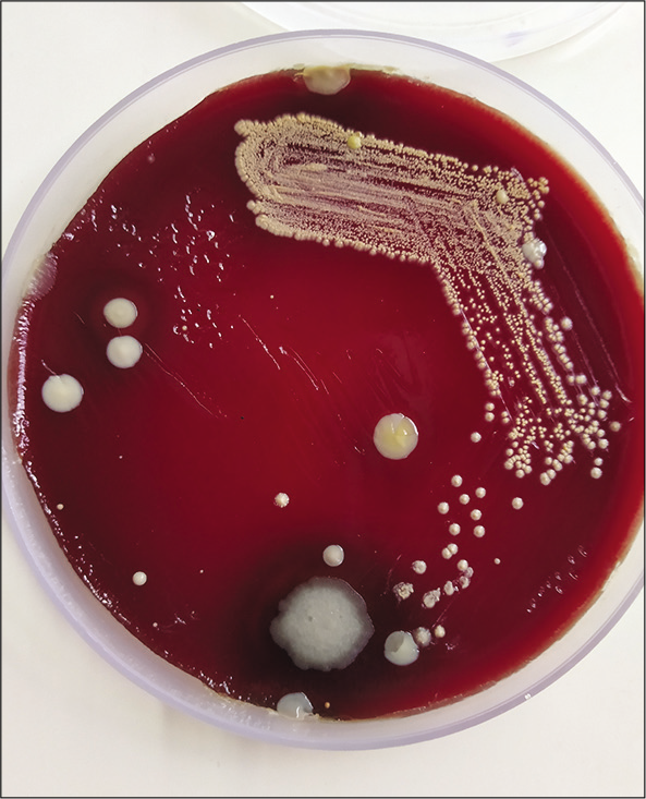 Culture of pus on blood agar showing chalky white cotton candy appearance of Nocardia colonies.