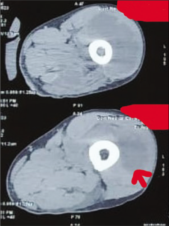 Computed tomography showing intramuscular collection (red arrow) in anterior and lateral compartment of the left thigh.