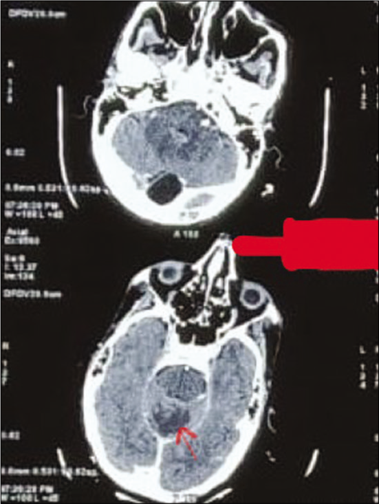 Computed tomography brain showing ill-defined hypodensity (red arrow) in the cerebellar vermis.