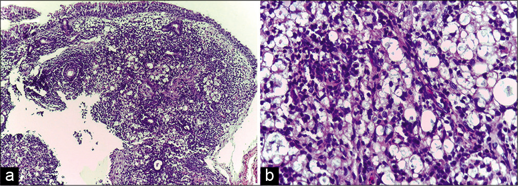 (a) Biopsy of the nasal cavity lesion showing macrophage granuloma with inflammatory infiltrate (H and E, ×100); (b) High-power view of the same showing inflammatory infiltrate composed of lymphocytes and a few neutrophils (H and E, ×400).