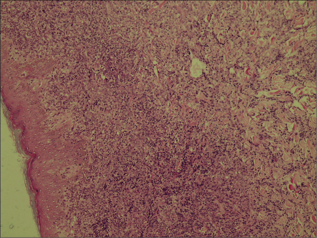 Large lymphoid cells with moderate cytoplasm and scattered mitotic figures. Inflammatory infiltrate extending up to the subcutaneous tissue (H & E, ×100).
