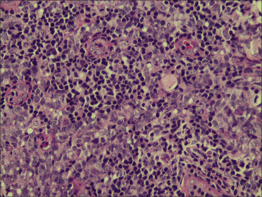 Higher magnification showing the large lymphoid cells and the mitotic figures (H & E, ×400).