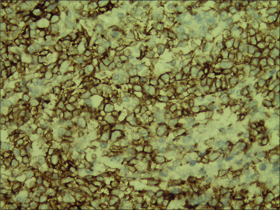 Inflammatory infiltrate showing strong and diffuse staining for CD30 (immunohistochemistry, ×400).