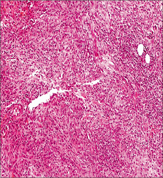 Biopsy from the erythematous plaque showing mild dermal fibrosis and mixed inflammatory infiltrate composed of lymphocytes, plasma cells, neutrophils, and occasional eosinophils (H and E, ×100).