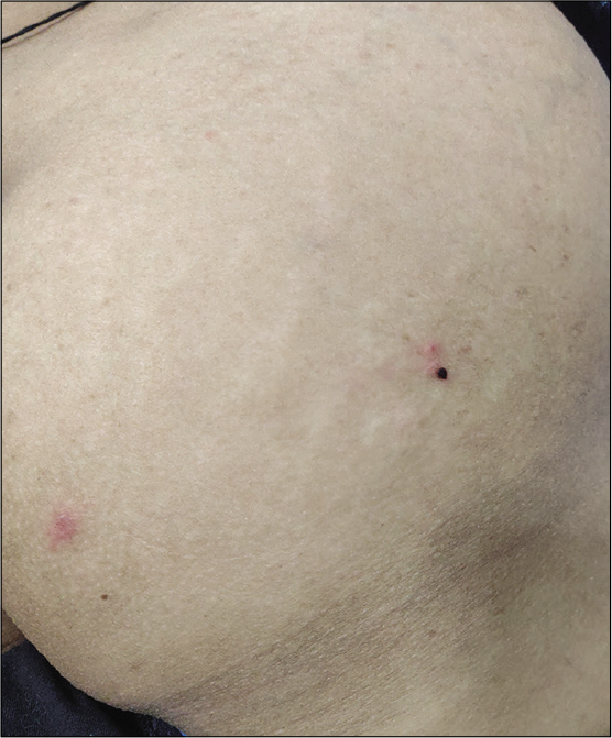 Discrete erythematous plaques over left buttock with one of the lesions showing hyperpigmented spot.