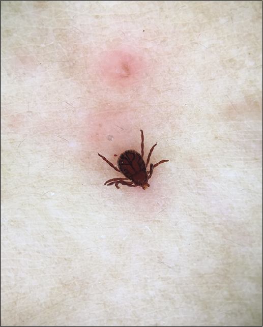 Dermoscopy (Dermlite DL4N, polarized mode, ×10) showing 8-legged live tick attached to the diffuse erythematous area.