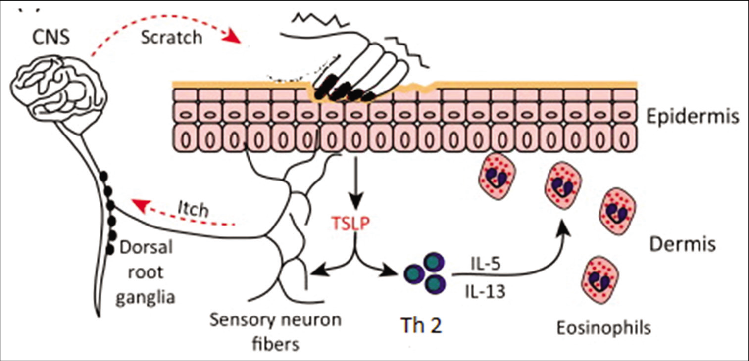 Pathogenesis of atopic dermatitis: Current concepts - Journal of