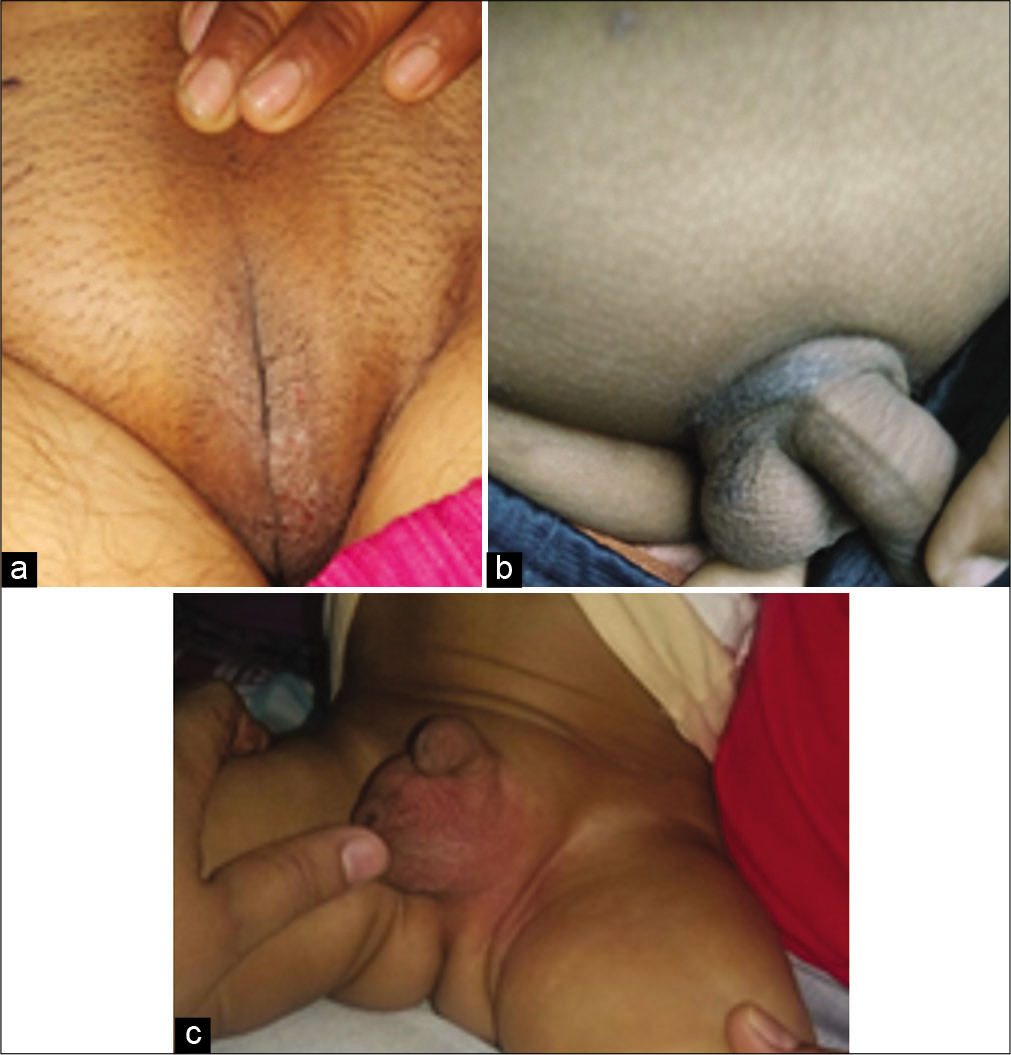 (a) vulvar eczema (b) Genital eczema (pubic area) (c) scrotal eczema.