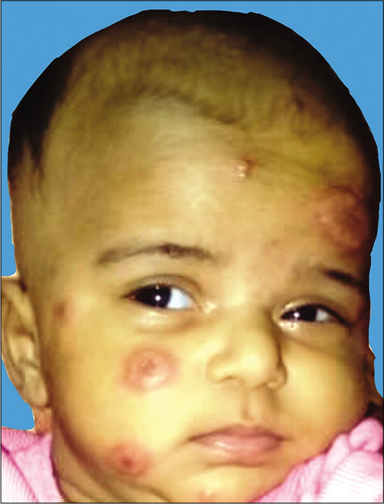 Erythematous plaque with central cyanotic hue on the face of an infant with multisystem inflammatory syndrome in children (1st day of admission).