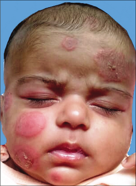 The same child shown in Figure 1 on the 2nd day of admission. Note the increase in size of the rash.