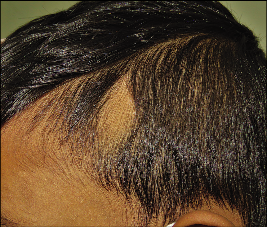 Congenital triangular alopecia - Journal of Skin and Sexually ...