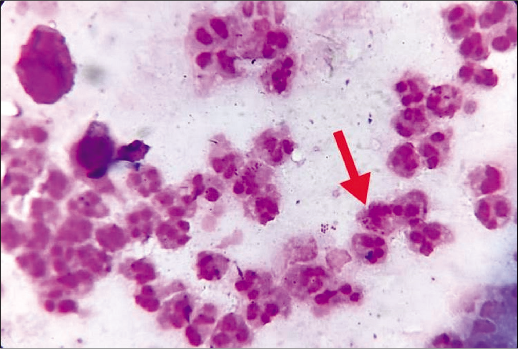 Gram stain of urethral smear. Red arrow indicates neutrophils with Gram-negative, intracellular and reniform diplococci (Gram stain, ×1000).