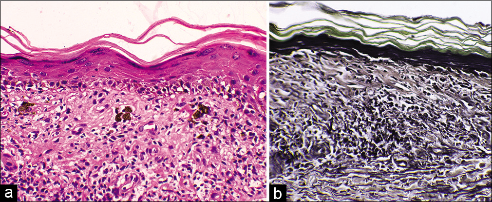 (a) Atrophic epidermis with spongiosis and basal cell vacuolization. Dermal infiltrate of lymphocytes, polymorphs, a few plasma cells, eosinophils, melanophages, and apoptotic keratinocytes (Hematoxylin-eosin, ×400) (b) Absent elastin fibers in superficial dermis (Verhoeff van Gieson stain, ×400).