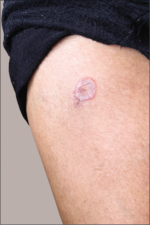 Koebner phenomenon – new lesion developing over the scar on the right leg.