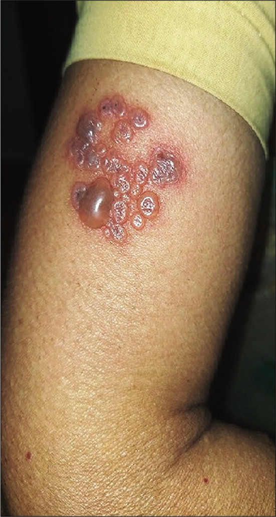 Multiple grouped vesicular lesions of herpes zoster following COVID-19 vaccination.