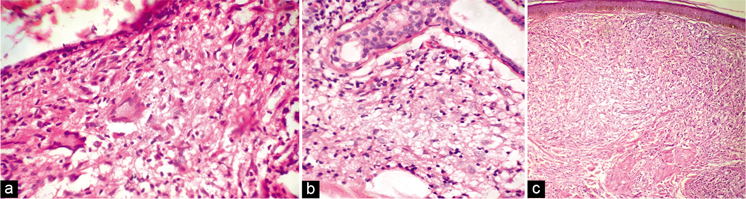 (a) Skin biopsy from the lesion of tubeculoid leprosy showing epithelioid granuloma and Langhan’s giant cell (H and E, ×400); (b) Skin biopsy from the lesion of borderline lepromatous leprosy showing macrophage granuloma (H and E, ×400); (c) Skin biopsy from the lesion of lepromatous leprosy showing sheets of foamy macrophages (H and E, ×400).