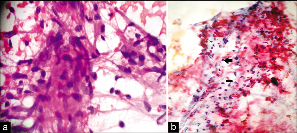 (a) Fine-needle aspiration cytology smear from the lesion of tuberculoid leprosy showing cohesive epithelioid cell granulomas and numerous lymphocytes not infiltrating the granuloma (Papanicolaou stain, ×400); (b) Fine-needle aspiration cytology smear from the lesion of borderline lepromatous leprosy showing moderate cellularity and numerous lymphocytes (left arrow) admixed with macrophages (right arrow) (Papanicolaou stain, ×400).