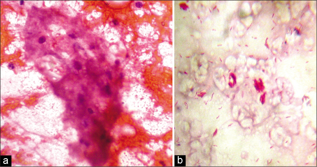 (a) Fine-needle aspiration cytology smear from the lesion of lepromatous leprosy showing foamy macrophages in a fatty back ground and a few lymphocytes (Papanicolaou stain, ×400); (b) fine-needle aspiration cytology smear from the same lesion showing globi (Ziehl-Neelsen stain, ×1000).