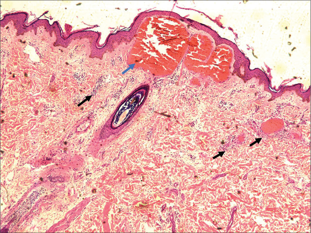Histopathology demonstrating a slightly atrophic epidermis with elongated rete ridges partially enclosing dilated papillary vessels resembling large cavernous channels (blue arrow), and sparse perivascular lymphocytic infiltrates (black arrows) (H&E, ×10).