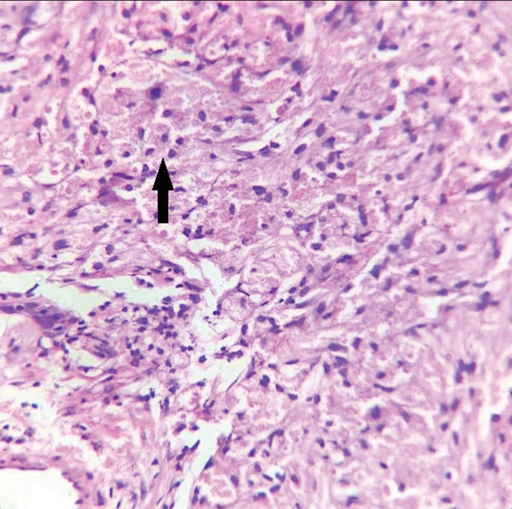 Sheets of well-defined polyhedral cells with granular eosinophilic cytoplasm and central basophilic nuclei (arrow) in the dermis, H & E ×400.