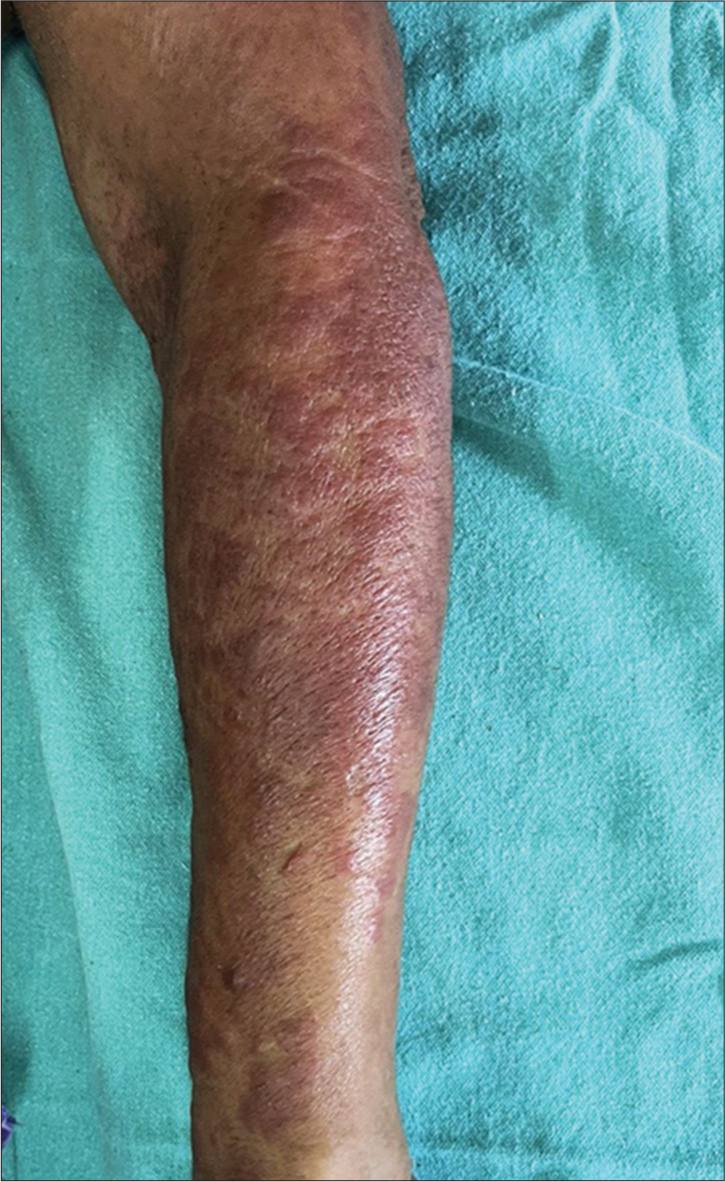 Erythematous papules and plaques on the forearm.