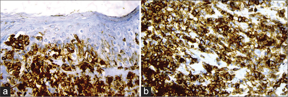 (a) Immunohistochemistry (IHC) showing CD3 positive and (b) CD4 positive cells, ×400.