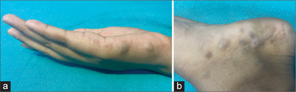 (a): Hemangiomas present over the ulnar border of the right hand; (b): Hemangiomas present over the medial border of the left foot.