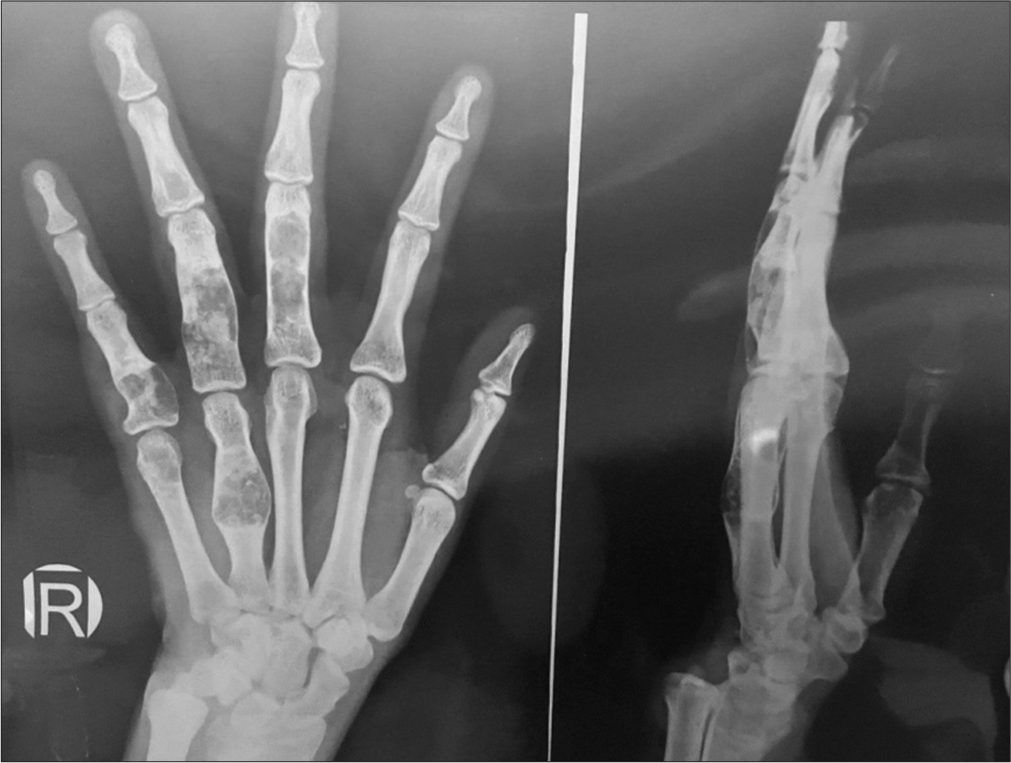 X-ray of the right hand AP and lateral shows multiple well-defined expansile lytic lesions involving metaphysis of 4th metacarpal, 3rd and 4th proximal phalanges, epiphysis of 5th metacarpal and proximal phalanx. The lesions show type 1a margin with narrow zone of transition. Internal linear and round radiopaque foci are seen, consistent with chondroid internal matrix.