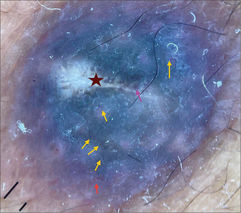 Dermoscopic findings of hemangioma over left foot: Bluish-pink background, white scales, whitish lacunae (maroon star), dotted vessels (red arrow), hairpin vessel (pink arrow), linear vessels (yellow arrows). (Dermlite DL4 10X magnification polarised mode with pigment boost).