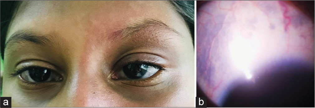 (a) Nevus of Ota; (b): Scleral melanocytosis.