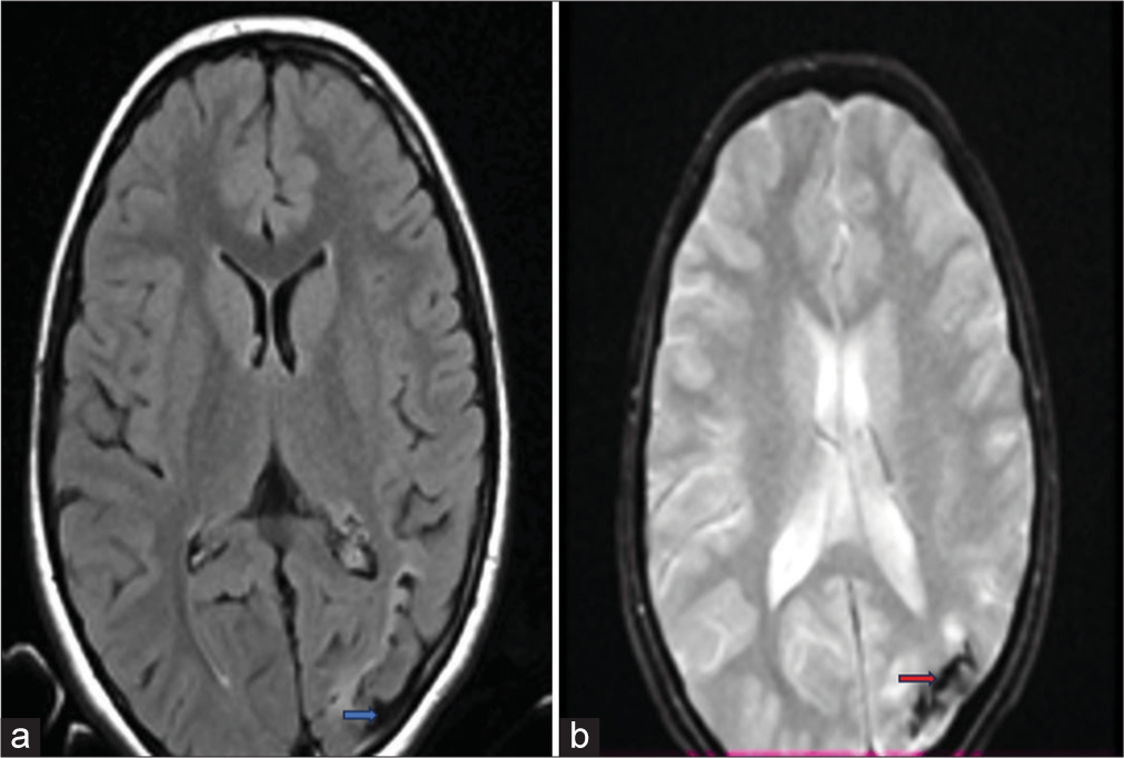 (a) MRI SWI image showing volume loss (Blue arrow); (b): MRI FLAIR image showing calcifications (Red arrow). MRI: Magnetic resonance imaging, SWI: Susceptibility-weighted imaging, and FLAIR: Fluid-attenuated inversion recovery.