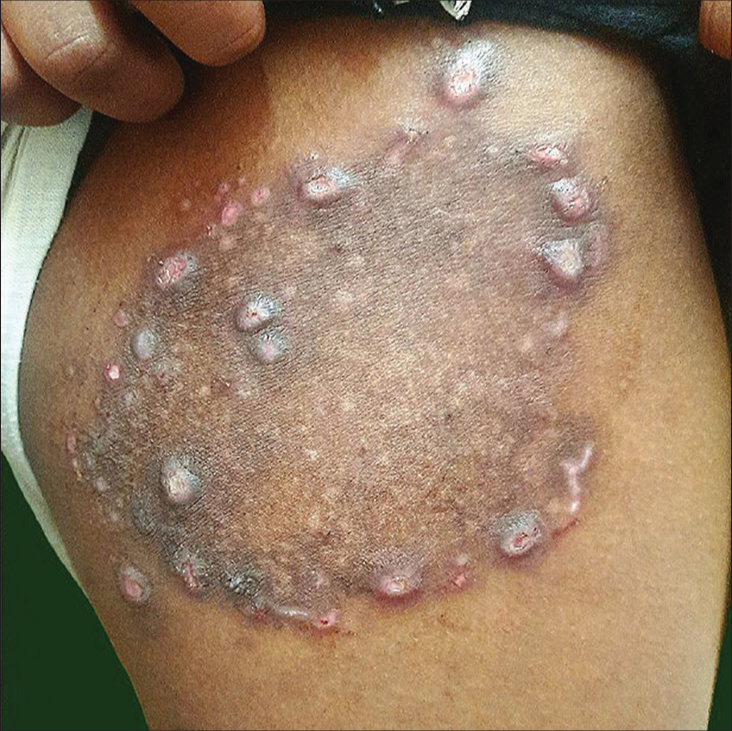 Clinical image showing annular plaque with peripheral follicular papules.